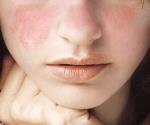 ¿Cuáles son los síntomas más comunes del lupus?