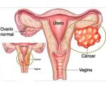 Lo que debes saber sobre el cáncer de ovario